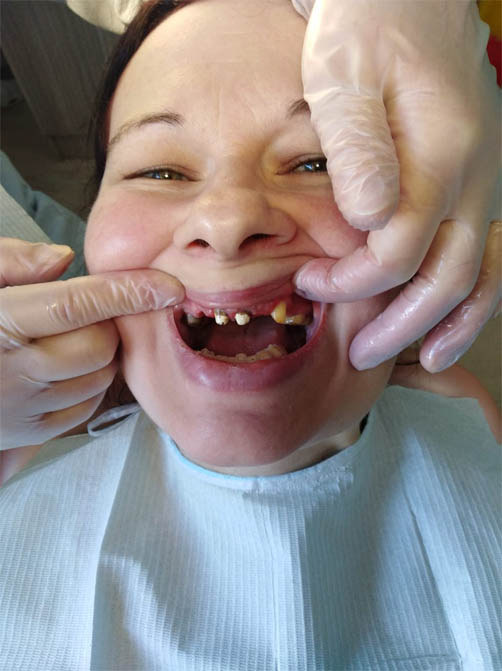 до протезирования зубов 